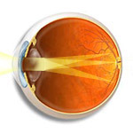 common-astigmatism-Northcliff Optometrist