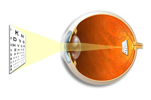 common-eye-conditions Northcliff Optometrist