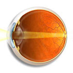 common-hyperopia-Northcliff Optometrist