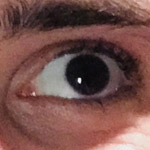 common-strabismus-Northcliff Optometrist