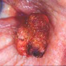 northcliff optometrist-basal-cell-carcinoma