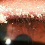 northcliff optometrist-blepharitis