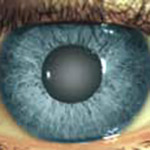 northcliff optometrist-cataract