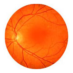 northcliff optometrist-central-serous-chorioretinopathy