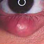 northcliff optometrist-chalazion