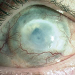 northcliff optometrist-chemical-burn