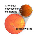 northcliff optometrist-choroidal-neovascular-membrane