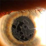 northcliff optometrist-cogans-dystrophy