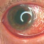 northcliff optometrist-conjunctivitis