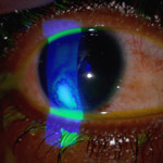 northcliff optometrist-corneal-ulcer