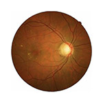 northcliff optometrist-cystoid-macular-oedema