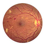 northcliff optometrist-diabetic-retinopathy