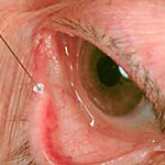 northcliff optometrist-dry-eye-syndrome