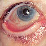 northcliff optometrist-ectropion