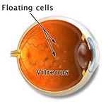 northcliff optometrist-flashes-floaters