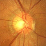 northcliff optometrist-glaucoma