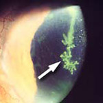 northcliff optometrist-herpes-simplex
