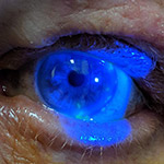 northcliff optometrist-herpes-zoster