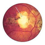 northcliff optometrist-histoplasmosis