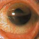 northcliff optometrist-hyphema