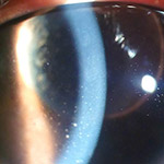 northcliff optometrist-iritis