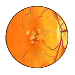 northcliff optometrist-macular-degeneration