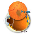 northcliff optometrist-naevus