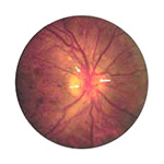 northcliff optometrist-neovascularizatio-optic-nerve-head