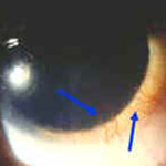 northcliff optometrist-neovascularization