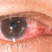 northcliff optometrist-ocular rosacea
