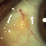 northcliff optometrist-pinguecula