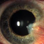 northcliff optometrist-pterygium