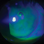northcliff optometrist-recurrent-corneal-erosion