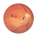 northcliff optometrist-retinal-artery-occlusion