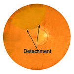 northcliff optometrist-retinal-detachment