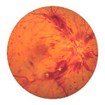 northcliff optometrist-retinal-vein-occlusion