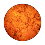 northcliff optometrist-retinitis-pigmentosa
