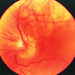 northcliff optometrist-retrolental-fibroplasia