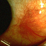 northcliff optometrist-scleritis