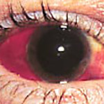 northcliff optometrist-subconjunctival-haemorrhage