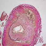 northcliff optometrist-temporal-arteritis