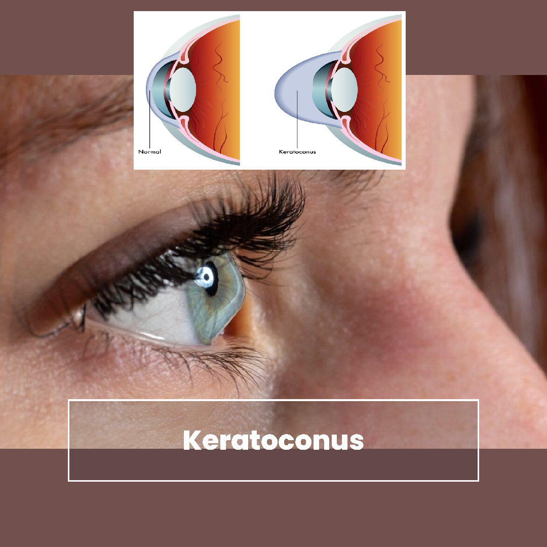 keratoconus optometrist in northcliff johannesburg